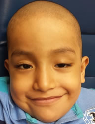 Preoperative ptosis left eye