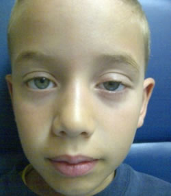 Preoperative ptosis left eye