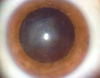Cataract is a white opacity of the normally clear lens. Note photograph shows a cloudiness within the black pupil – that cloudiness is the cataract.