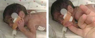 Very low birth weight premature infant (birth weight 750 grams) at Cedars-Sinai Medical Center Neonatal ICU.