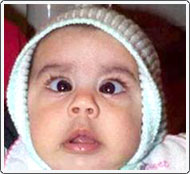 Very young child with very prominent congenital esotropia.