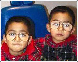 Twins with esotropia (crossed eyes) and hypermetropia. The glasses corrected the esotropia and they did not need surgery.