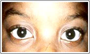 Eyes are aligned and held straight with convergence - a form of motor fusion.