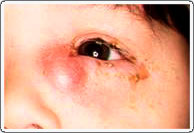 Infected nasolacrimal duct (amniotocele) requiring urgent probing and antibiotics.