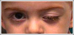 Child with left third nerve palsy after a virus. The left eyelid is droopy (ptotic), and the left eye is slightly down and out when the right eye looks straight ahead.