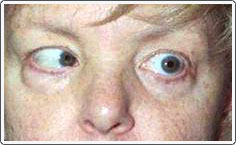 Patient with left sixth nerve palsy. Pre-operative photo shows inability of the left eye to turn out in left gaze.