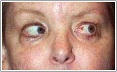 Post-operative photo shows recovered ability for the left eye to turn out in left gaze.