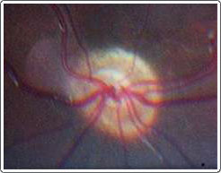 Through fundus photography, we are able to see the optic nerve in the back of the eye. In patients with optic nerve hypoplasia, the rim of the nerve is blurred and extended out onto the retina. The size of the center is smaller than normal.