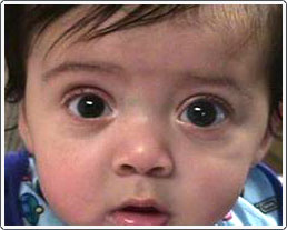 Young child with unilateral congenital glaucoma, left eye. Note the larger size of the left eye (buphthalmos) compared to the right eye. This is a classic sign of congenital, unilateral glaucoma.