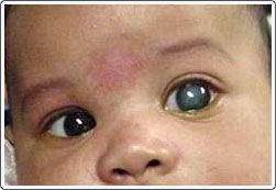 Congenital glaucoma, left eye. There is a cloudy cornea, enlarged eye, and strabismus.