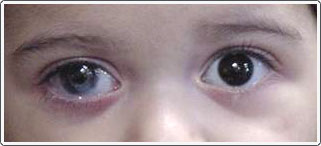 Young child with Peter's anomaly, right eye. Note the whitish opacity on the cornea, which later required a corneal transplant. Patient also had a cataract that required removal and is currently being treated for glaucoma related to Peter's anomaly. The patient wears a contact lens to try and improve the amblyopia caused from the cataract and corneal opacity. Patching of the good eye is being done.