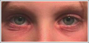 The patient has severe contact irritation of the lower lid skin secondary to ocular allergic conjunctivitis. 