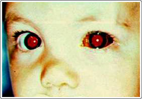 Child with H-flu and hemorrhagic conjunctivitis in the left eye. The bleeding usually clears up on its own in a couple of weeks.