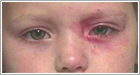 Child with chemical conjunctivitis caused by contact with nail polish. The eye and skin cleared up with no lasting side effects.