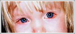 Child with bilateral blepharitis. Note the redness of the lid margins caused by irritation. There is tearing and some redness of the white part of the eye.