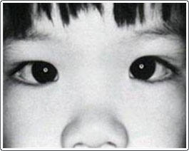 Note the light reflexes in the center of the pupils. They are centered and equal. However, the eyes look like they are crossing because of the very wide nasal bridge.