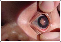 Newborn with retinoblastoma, left eye. Note the whitish shape seen through the pupil. This is a tumor in the back of the eye.