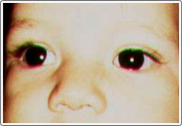 Child with exotropia and slight hypertropia of the right eye caused by a retinoblastoma tumor in that eye. Note the location of light reflexes on the pupils.