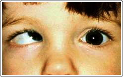 Child with infantile esotropia. The right eye is stuck up and in as the left eye is fixing straight ahead.