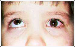 Child with a right hypertropia. The right eye is in the elevated position when the left eye looks straight ahead.