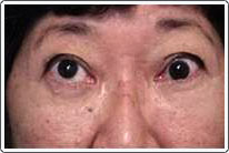 Thyroid_Strabismus1