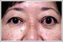 Thyroid_Strabismus2