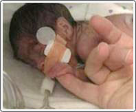 Very tiny premature baby at risk for retinopathy of prematurity. Patient was born weighing only 750 grams.